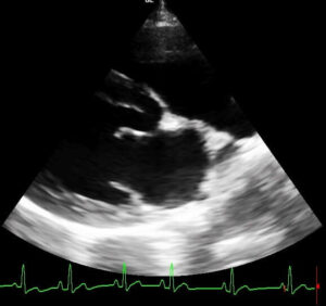 Echographie cardiaque