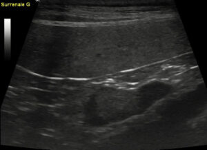 Echographie abdominale