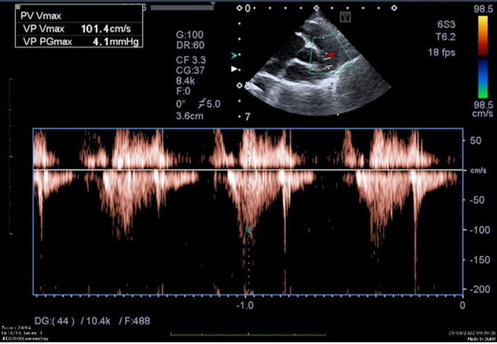 examen d'échocardiographie