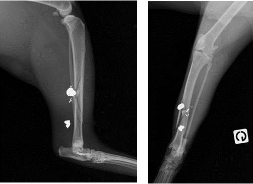 Fracture ouverte diaphysaire comminutive du tibia gauche avec 2 plombs