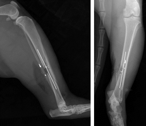 Figure 2 : Retrait de 2 plombs et mise en place d'un clou centro-médulaire