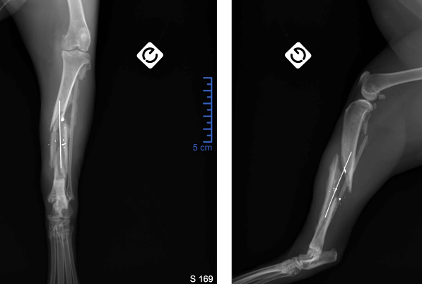 Figure 3 : Dégradation de la réduction, 14 jours post-opératoires